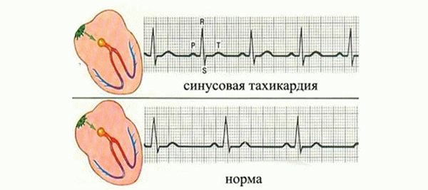 синусовая тахикардия