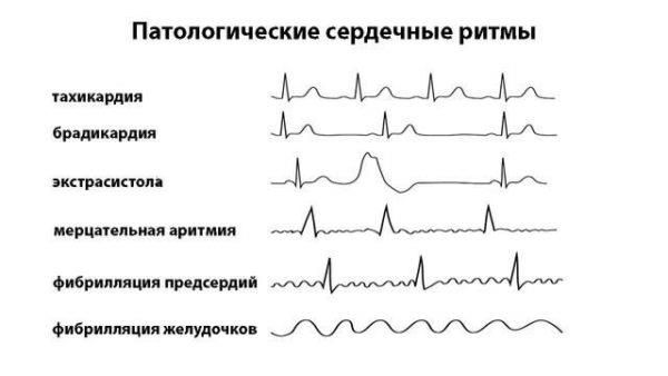 Аритмия